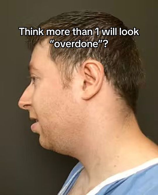 Video by Dr. Mark G. Albert: The power of combo procedures— in this patient’s case, he underwent a chin augmentation + a rhino…
