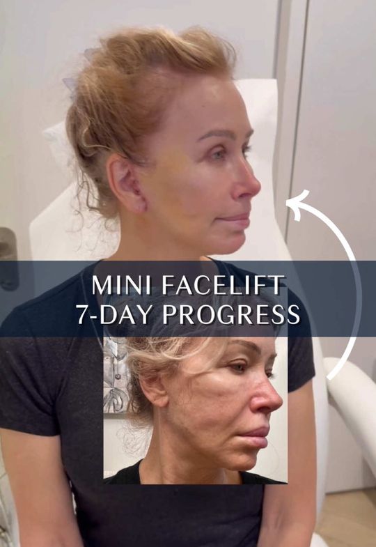 Video by Dr. Mark G. Albert: Remember her from 3 days post-op? 👇🏻 Last Wednesday, we showed her Mini Facelift progress just…