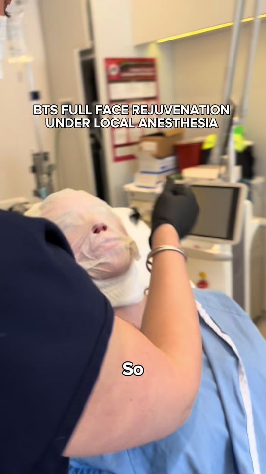 Video by Dr. Mark G. Albert: Full face under local anesthesia This patient underwent a customized combination of: • Mini facel…