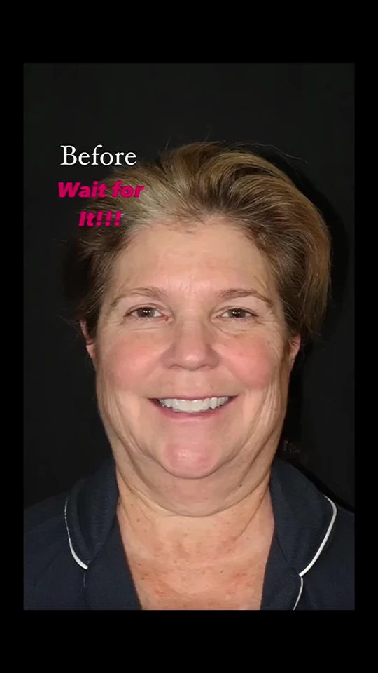 Video by Dr. Mark Karolak: At 4 months after her facial rejuvenation procedures, this beautiful 56 year old looks amazing!!!…