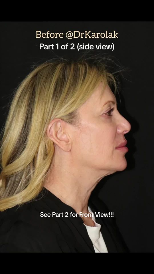 Video by Dr. Mark Karolak: I have known this beautiful patient for almost 10 years. It’s such an honor to be the surgeon she…
