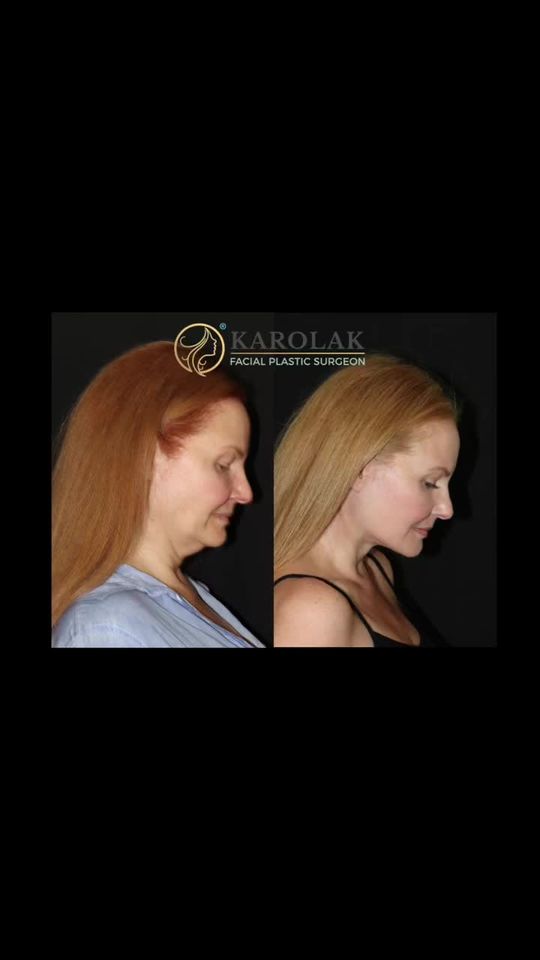 Video by Dr. Mark Karolak: What did she do?! (See below) At 50 y/o, this patient looks refreshed, youthful, and elegant!!! S…