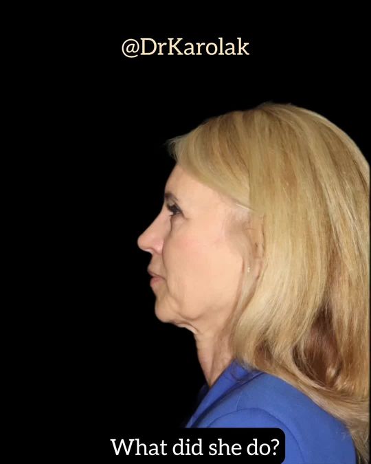 Video by Dr. Mark Karolak: At 58, this beautiful patient is going into the holiday season and ready to ring in the with a sp…