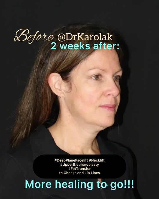 Video by Dr. Mark Karolak: This beautiful 45 y/o patient is on her way back to 2 weeks after having her and facial revolumiz…