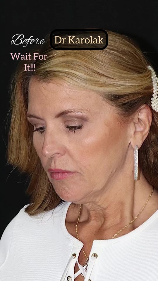 Video by Dr. Mark Karolak: This 59 year old patient came to visit me in New Jersey from Tennessee. I used my deep plane face…