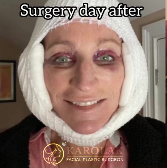 Video by Dr. Mark Karolak: When it comes to facelift recovery, healing times will vary from patient to patient. Some heal qu…