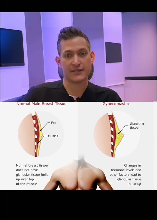 Video by Dr. Matthew A. DelMauro: Gynecomastia surgery isn’t just about removing fat—it’s about sculpting a natural, masculine ches…