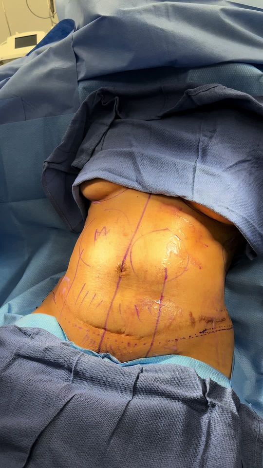 Video by Dr. Matthias Solomon: Tummy tuck revision today from a previous surgeon 👏🏼🤩 she will love these results 🙌🏼🥰