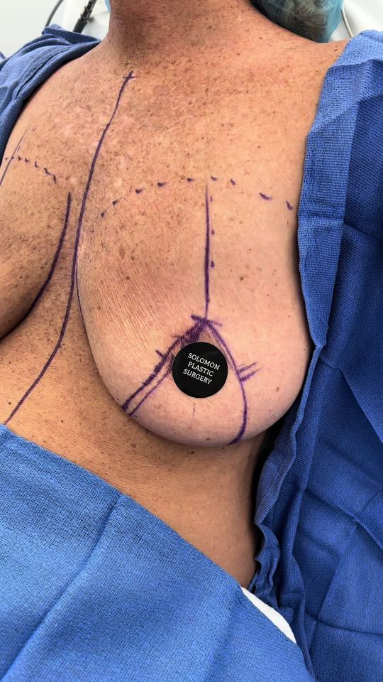Video by Dr. Matthias Solomon: 405 cc silicone implants with a lift 👏🏼