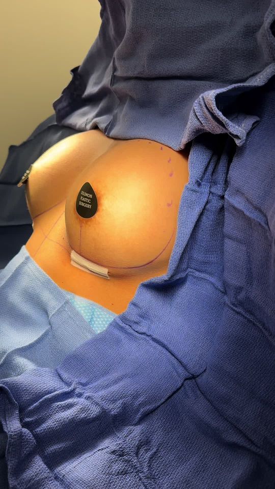 Video by Dr. Matthias Solomon: Another beautiful breast augmentation 👏🏼 375 ccs transformed this patient from an A cup to a sm…