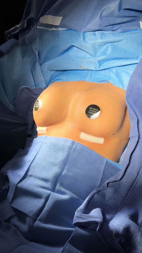 Video by Dr. Matthias Solomon: Our beautiful patient wanted a natural look that makes her feel confident in a swim suit. She is…