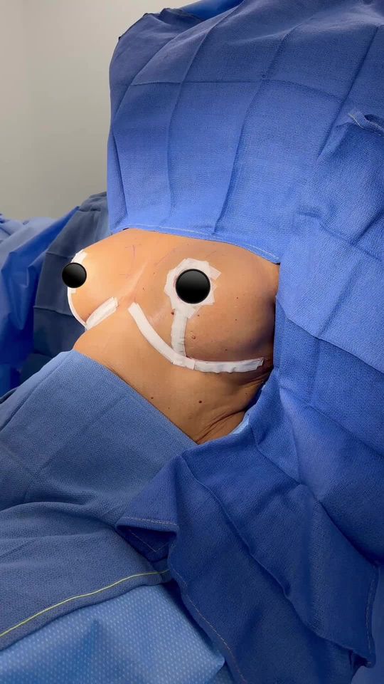 Video by Dr. Matthias Solomon: This patient in her early 70’s had an amazing result with her lift and silicone implant. We used…