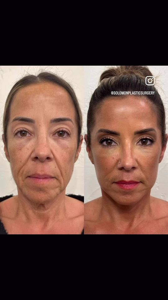 Video by Dr. Matthias Solomon: A true full-release deep plane face lift can restore youthful contours without a pulled look.