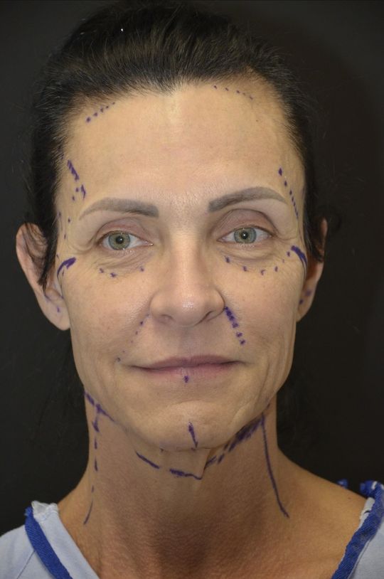Video by Dr. Matthias Solomon: A facelift should not change who you are. It should restore what time has quietly taken away. In…