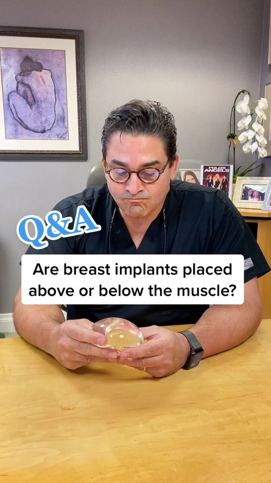 Video by Dr. Max Polo: Q&A: Are implants placed above or below the muscle? 🤔
