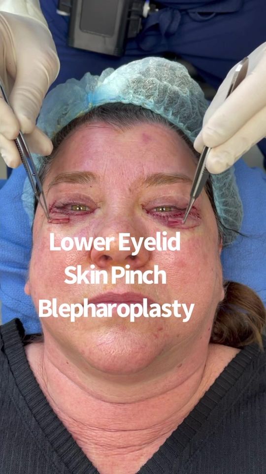 Video by Dr. Mehryar (Ray) Taban: SKIN PINCH LOWER BLEPHAROPLASTY: Small or large amount of lower eyelid skin can be removed safely…