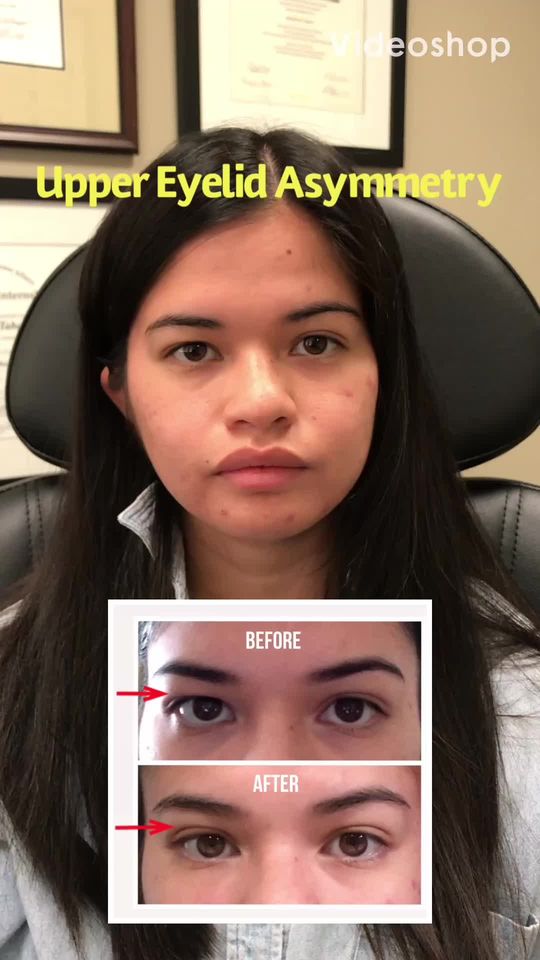 Video by Dr. Mehryar (Ray) Taban: UPPER EYELID ASYMMETRY: young beautiful lady @bvaxquez with congenital upper eyelid asymmetry und…