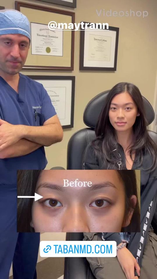 Video by Dr. Mehryar (Ray) Taban: Customized Asian Upper Blepharoplasty (Double Eyelid Surgery): Beautiful young woman @maytrann un…