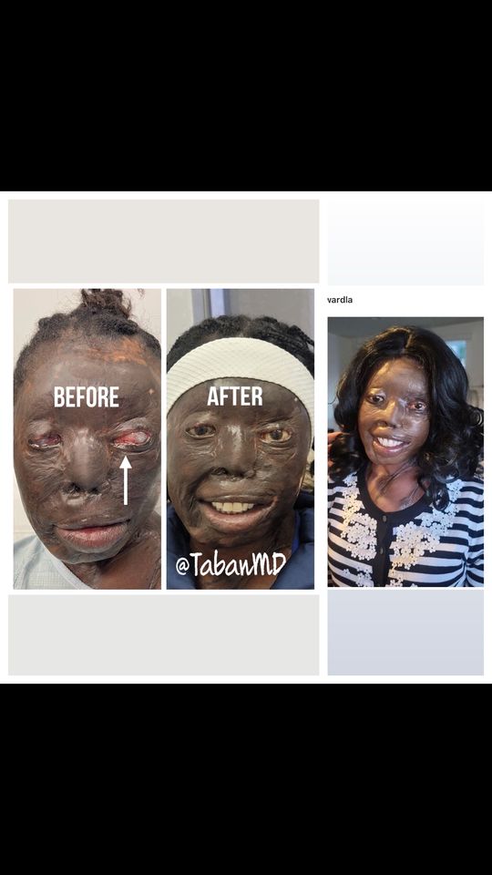 Video by Dr. Mehryar (Ray) Taban: UPDATE: Our brave acid victim woman underwent left eye removal followed by eye prosthesis. She is…