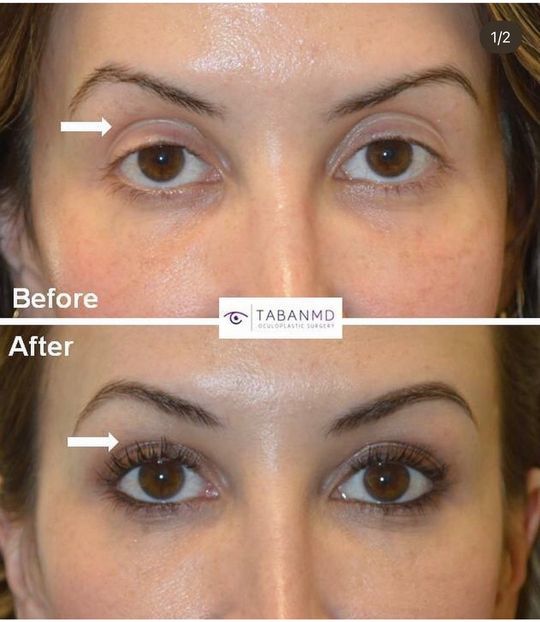Video by Dr. Mehryar (Ray) Taban: This young lady, with tired eyes and droopy upper eyelids (ptosis) and upper eyelid hollowness (f…
