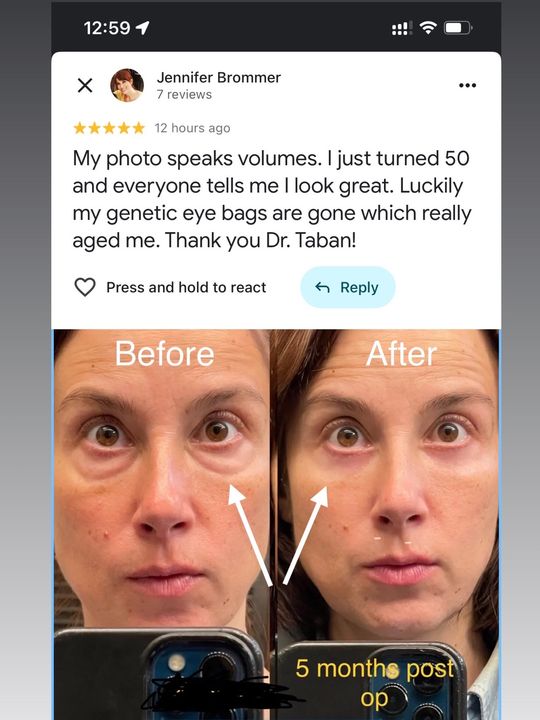 Video by Dr. Mehryar (Ray) Taban: 50 year old woman, with genetic and age-related eye bags, giving tired eyes appearance, underwent…