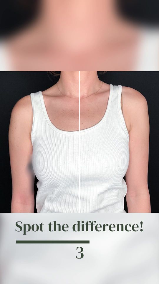 Video by Dr. Melissa Chiang: This lovely patient came in to see Dr. Chiang about her neck (trapezius) area to see if there was…
