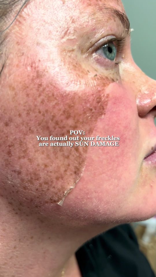 Video by Dr. Melissa Chiang: Her sun damaged skin peeled off! 🤯 Freckles are genetic, HOWEVER they appear and darken due to U…