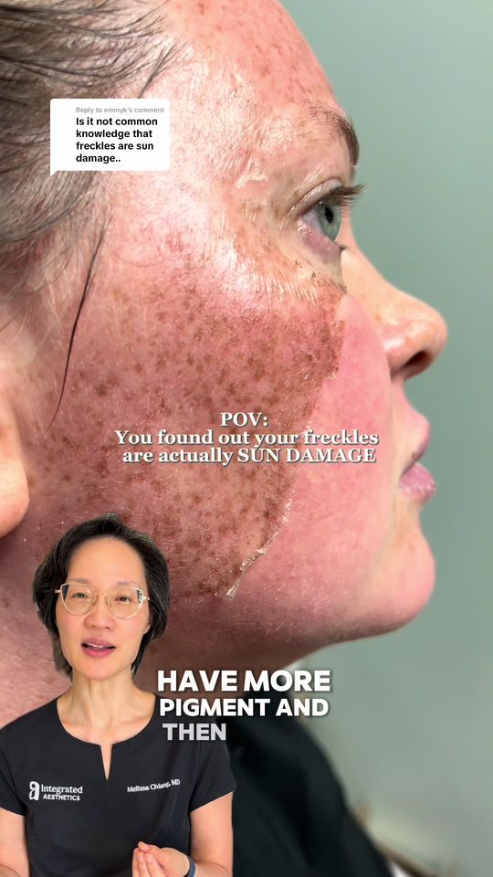 Video by Dr. Melissa Chiang: Replying to @emmyk You’re not born with freckles, but... 🫨 Freckles are the result of a combinat…