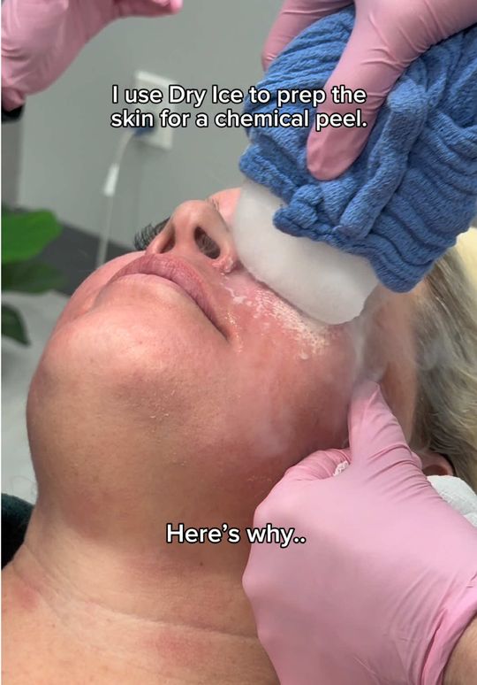 Video by Dr. Melissa Chiang: Yes, it’s dry ice. Yes there is a reason! 🧊 Would you try this treatment? 🤭 ⚠️EDUCATIONAL PURPO…