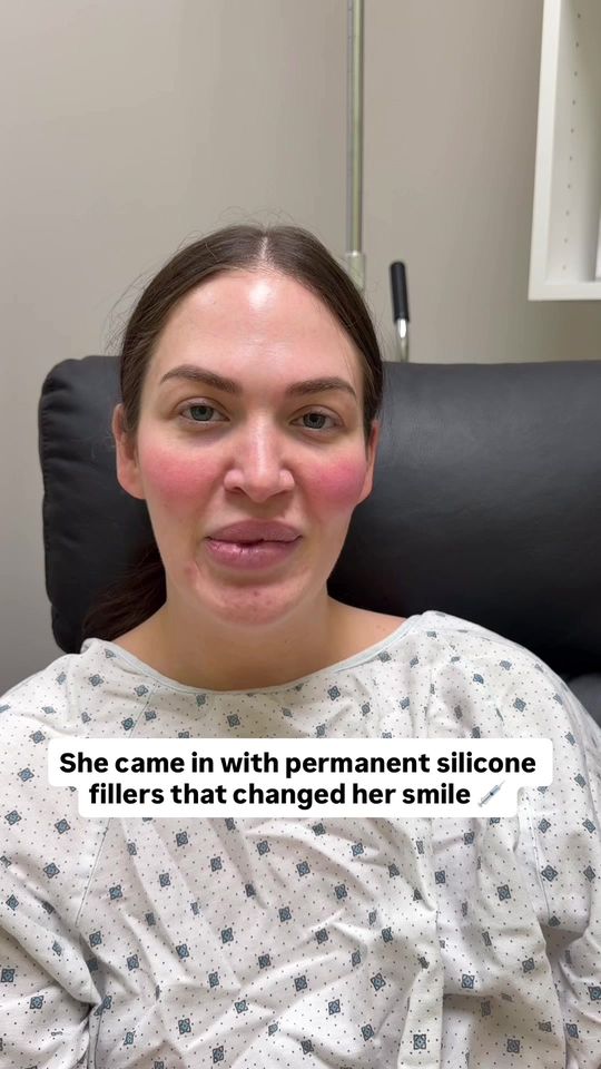 Video by Dr. Melissa Chiang: This patient came to us with permanent silicone lip fillers this is an illegal and banned substan…