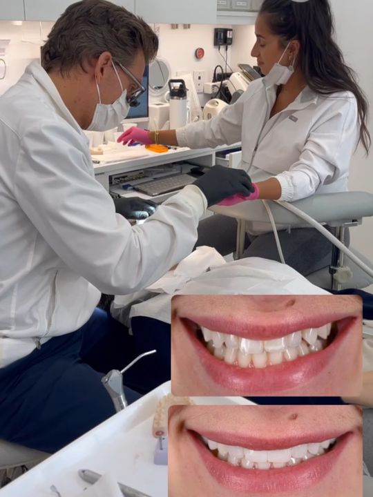 Video by Dr. Michael A. Apa: Back at it in after a productive trip to Time to insert this special patient's porcelain