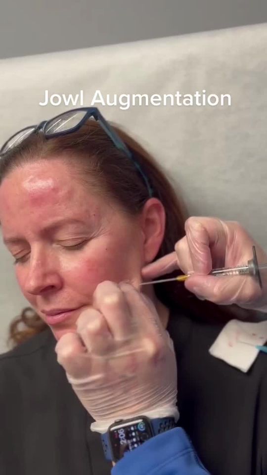 Video by Dr. Michael Kerin: This non-surgical jawline contouring with fillers uses a flexible cannula to carefully add volume…