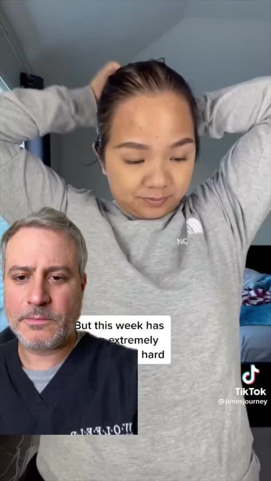 Video by Dr. Michael Wolfeld: Will hair loss make your hair shed? Dr. Wolfeld shares his knowledge on the connection between we…