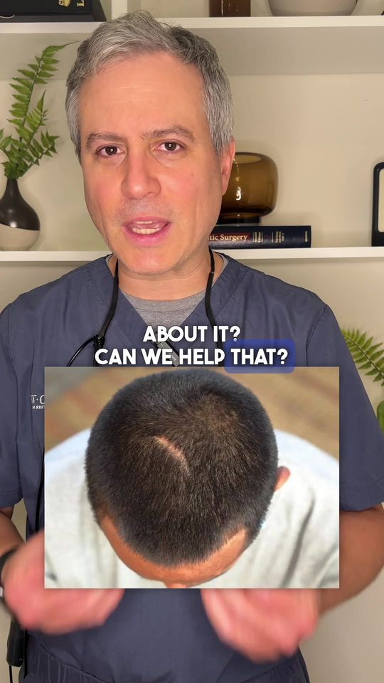 Video by Dr. Michael Wolfeld: Scars, being a common cause of hair loss, can be covered by the right hair transplant procedure.…