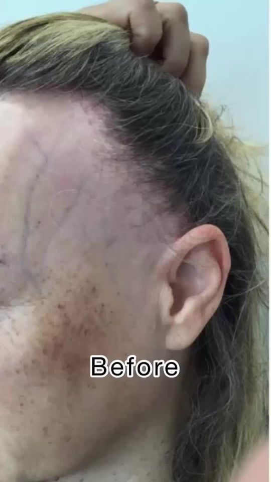 Video by Dr. Michelle Henry: My gorgeous patient has a diagnosis of frontal fibrosing alopecia. This is a type of scaring hair…