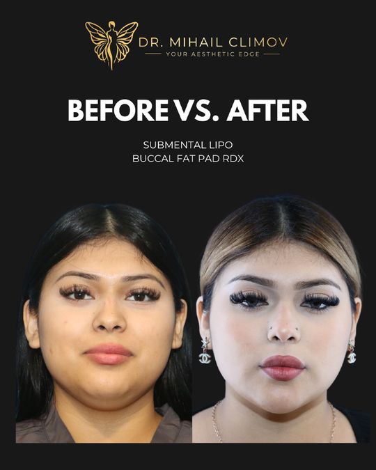 Video by Dr. Mihail Climov: Mogging who? 👀✨ Chin lipo + buccal fat removal = SNATCHED profile 💅 Sharp. Sculpted. Defined. �…