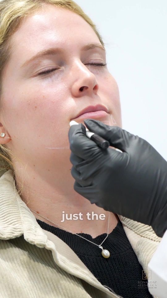Video by Dr. Monica Bonakdar: Chin Assessment PART 2: Today we have our second chin review. 💉 Today’s model has a slight cleft…