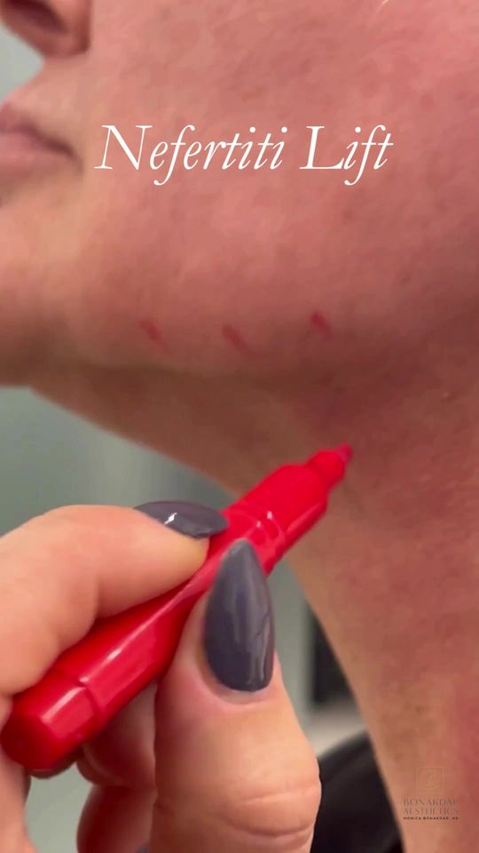 Video by Dr. Monica Bonakdar: Botox isn't just for smoothing wrinkles. The Nefertiti Lift is a non-surgical treatment using Bot…