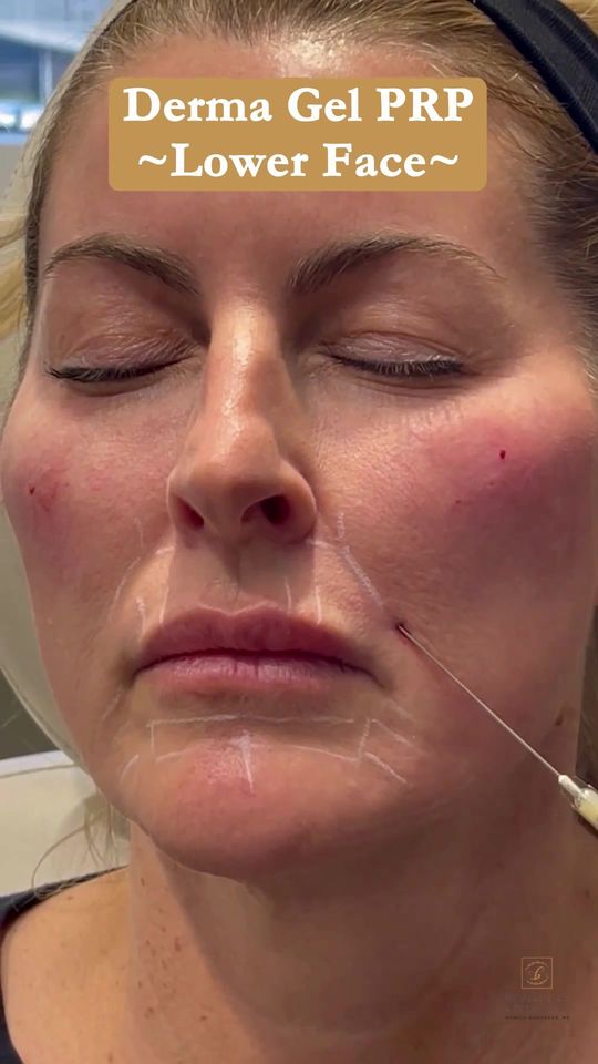 Video by Dr. Monica Bonakdar: Unlike laboratory made fillers, Derma Gel PRP utilizes your own blood to create a natural filler…