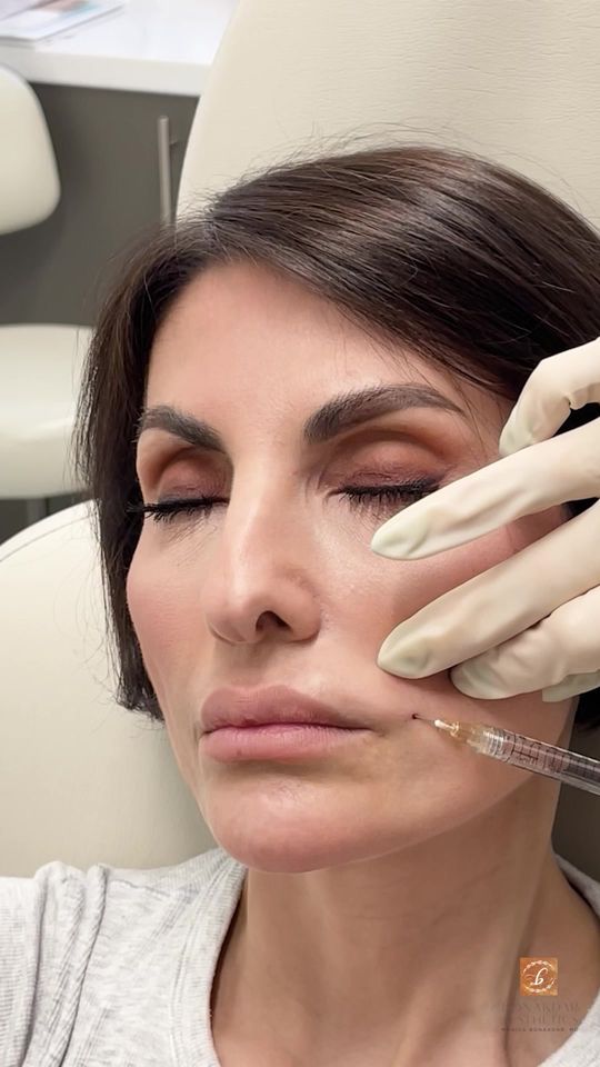 Video by Dr. Monica Bonakdar: Get your glow on this summer with just one SkinVive treatment!🌞 This innovative injectable gel b…