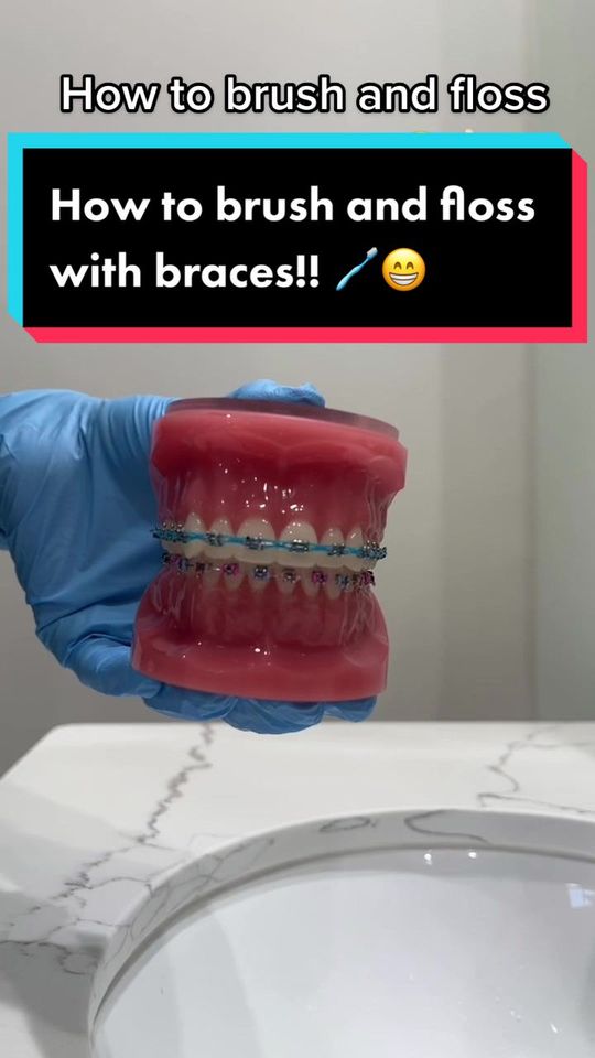 Video by Dr. Monica Velez, D: How to brush and floss with braces!! 🦷 😁