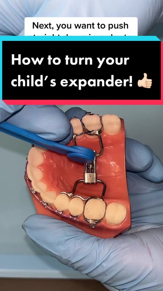 Video by Dr. Monica Velez, D: Here is a quick instruction video of how to turn your child’s palatial expander at home!! If you…