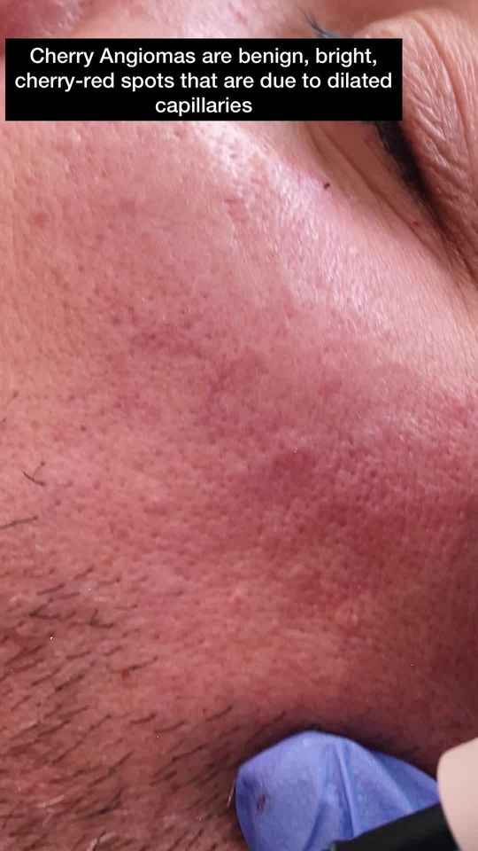 Video by Dr. Monika Kiripolsky: Cherry angiomas!