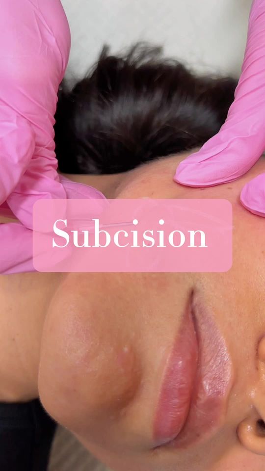 Video by Dr. Monika Kiripolsky: ✨ Subcision ✨ is a great procedure for all things acne scarring. When paired with our CO2 resurfa…