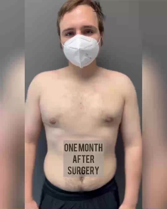 Video by Dr. Mordcai Blau: One month after gynecomastia surgery with Dr Blau