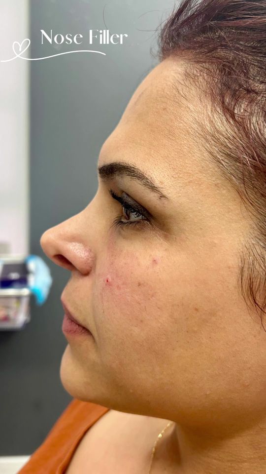 Video by Dr. Mytien Goldberg: My beautiful patient wanted to remove the deep slope on her nose, so I did liquid rhinoplasty to…