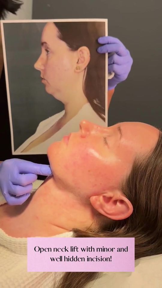 Video by Dr. Mytien Goldberg: I see patients in their 30s and 40s that have a double chin. A defined jawline in a woman present…