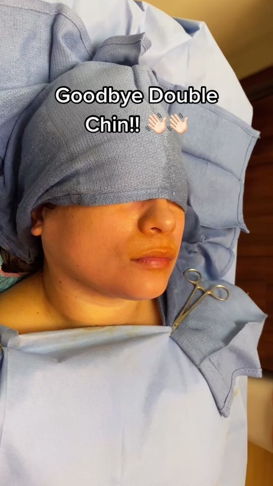 Video by Dr. Nadir Qazi: Our MicroLipo treatment! Lose your instantly