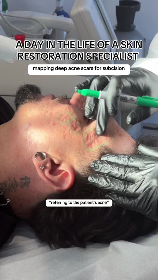 Video by Dr. Nadir Qazi: Nothing Spooky About Subcision 👻 When it comes to performing subcision, precision is key. Before…