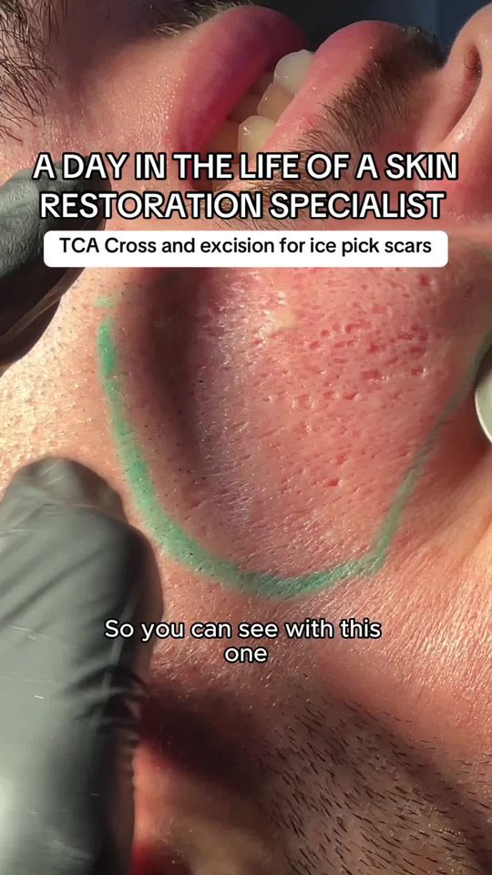 Video by Dr. Nadir Qazi: Treating deep, thick ice pick acne scars requires a precise and customized approach, and for this…